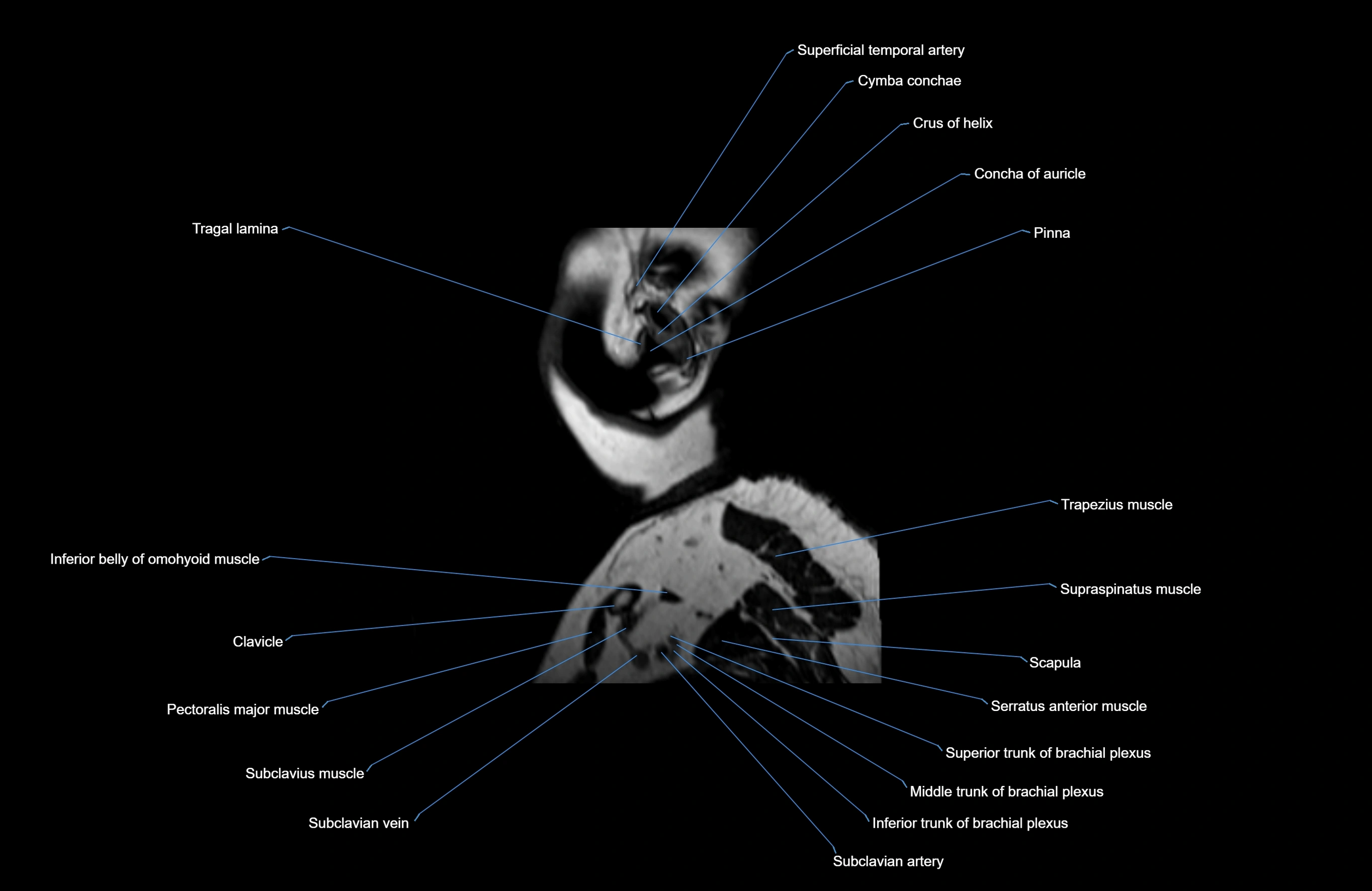 Neck MRI sagittal cross sectional anatomy 3D 1mm 3T radiology  image-img-00001-00043.webp